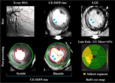 Left ventricular dyssynchrony measured by cardiovascular magnetic resonance-feature tracking in anterior ST-elevation myocardial infarction: relationship with microvascular occlusion myocardial damage